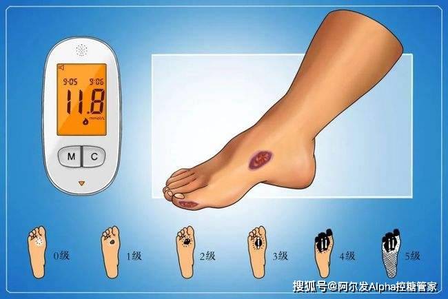 足部|糖友这样进行足部护理，才能跟糖尿病足说“不”