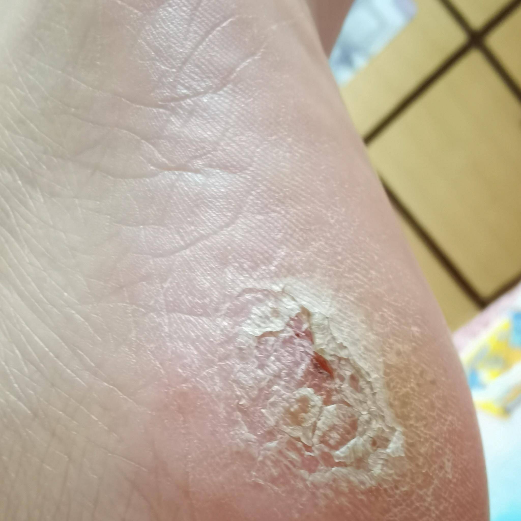 原创36岁脚后跟裂口子好几个月了怎么办