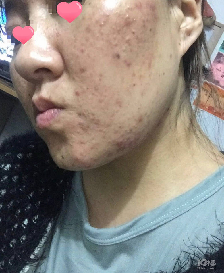 因为谭舒柳的祛痘是真的吗？谭舒柳有没有效果？