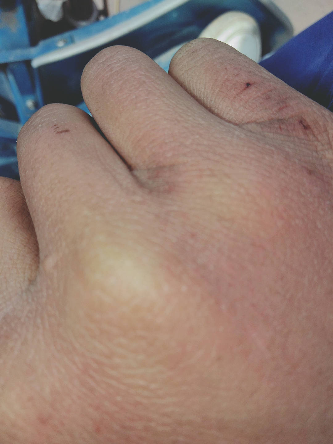 原创手指干裂长期不好这些禁忌是真是假