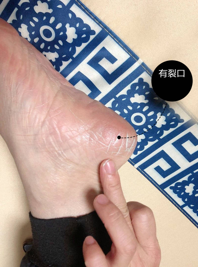 脚后跟干裂至今我该怎么办