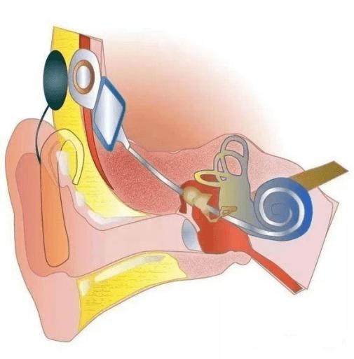關於人工耳蝸植入你瞭解多少二