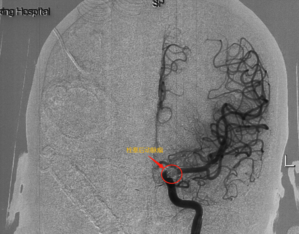 血管|头晕欲裂揪出颅内动脉瘤 医生极限“拆弹”化险为夷