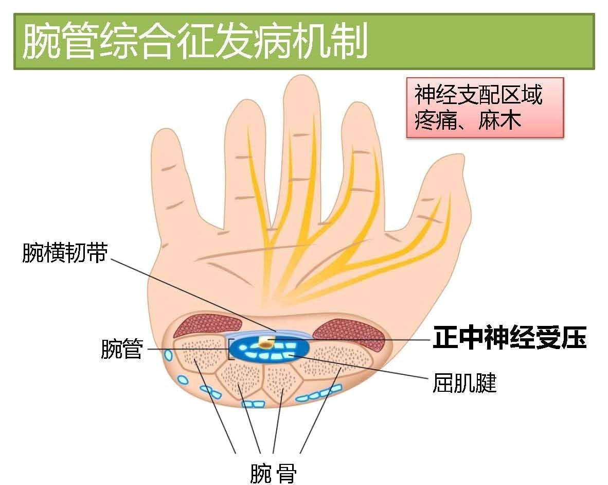 腕腕没想到「鼠标手」就这样被防住了_手腕_感觉_电脑