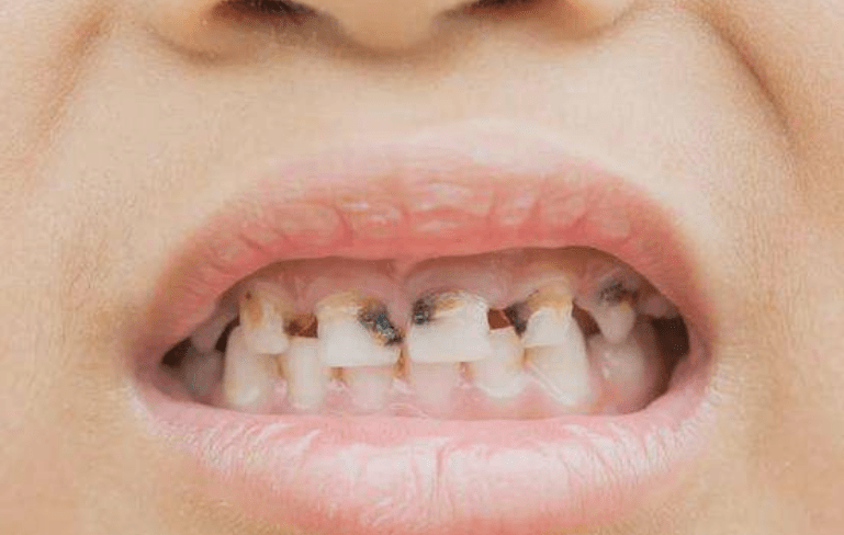 蛀牙后期图片图片