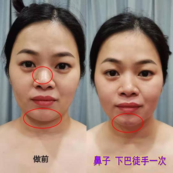 下巴法令纹整形 颧骨内推鼻子整形 下巴整形效果哪家好专业排名？专家用什么材料？