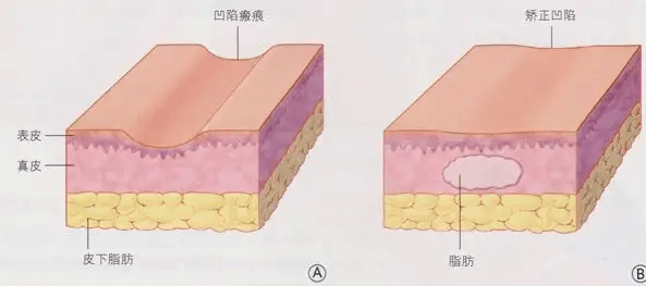 方法李佳佳院长带你了解面部填充