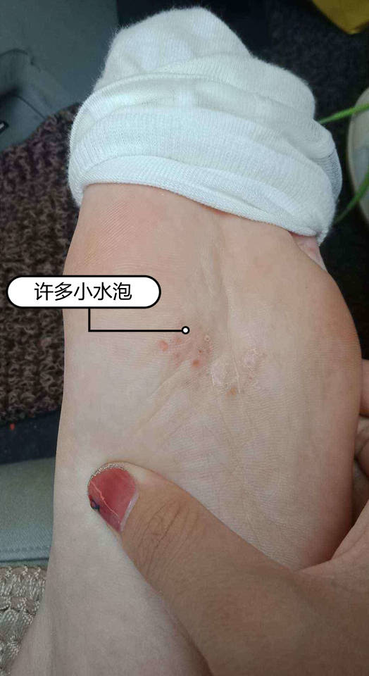 原创手上也跟着起了很多的小水泡怎么回事
