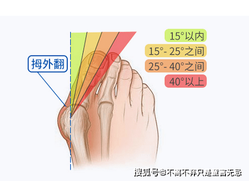 脚大拇指有几根筋图片图片