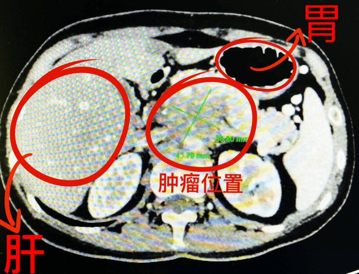 治疗|【抗癌故事】湖南长沙不可切除胰腺钩突癌患者的心声