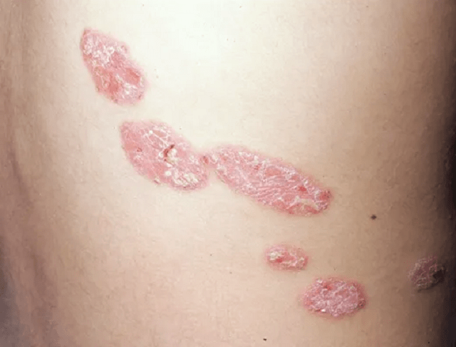 早期乳房湿疹样癌图片图片