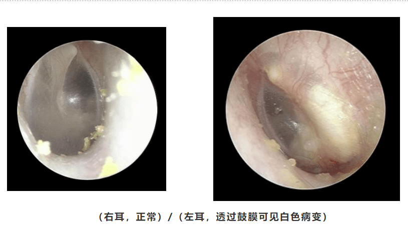 发现鼓膜发白莫大意可能罹患中耳胆脂瘤