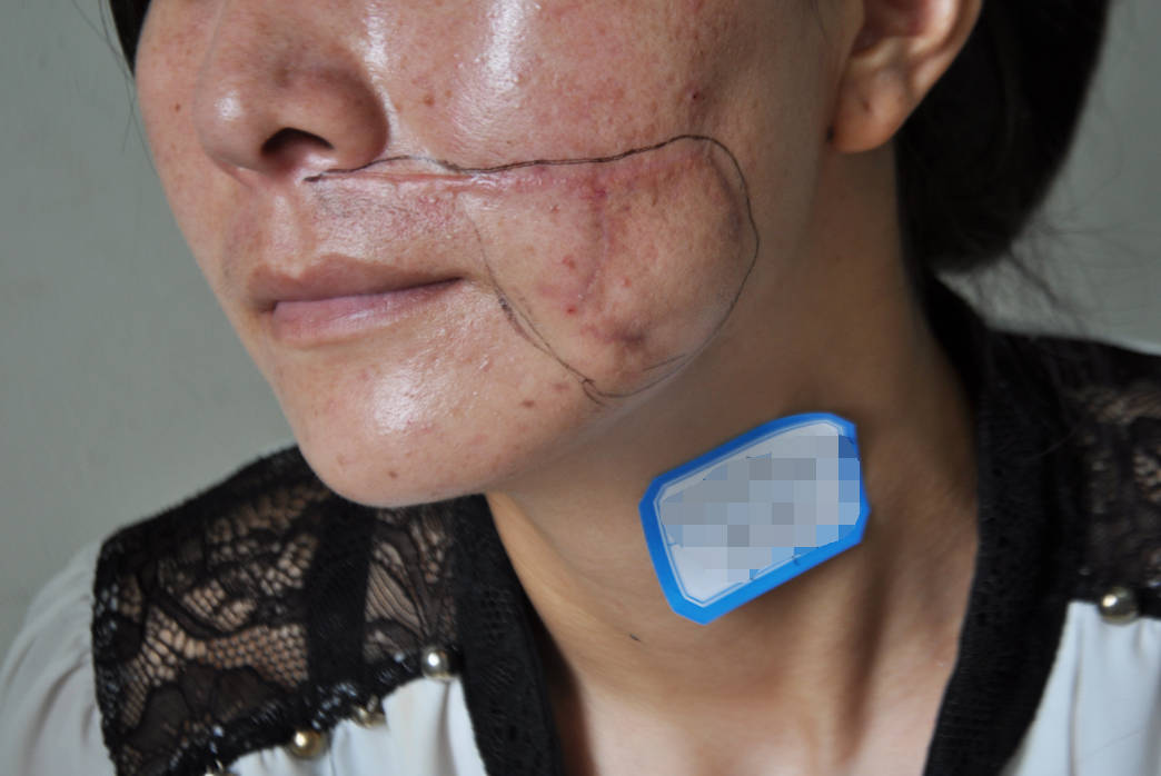 郑州市第二中医院科普凹陷性疤痕可以不治吗