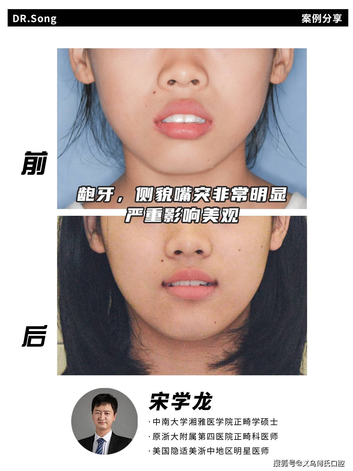 龅牙对脸型的影响图图片