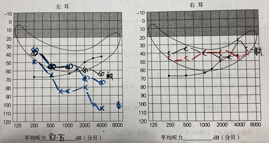 淮安助听器分享耳蜗内广泛存在耳蜗死区的听损者如何进行听力改善