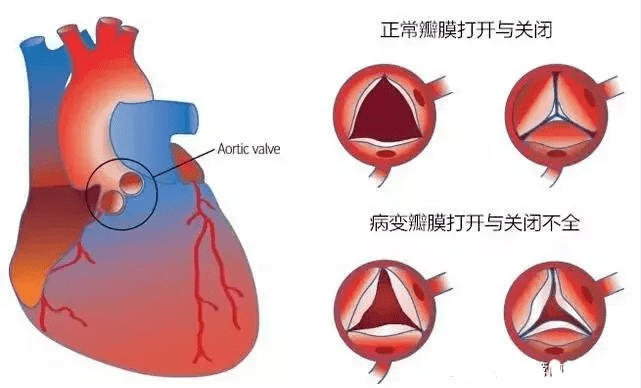 心脏三尖瓣反流 来自搜狐网