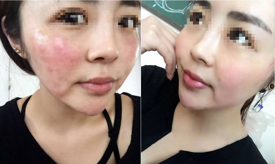 激素脸修复要多长时间?_皮肤_问题_治疗