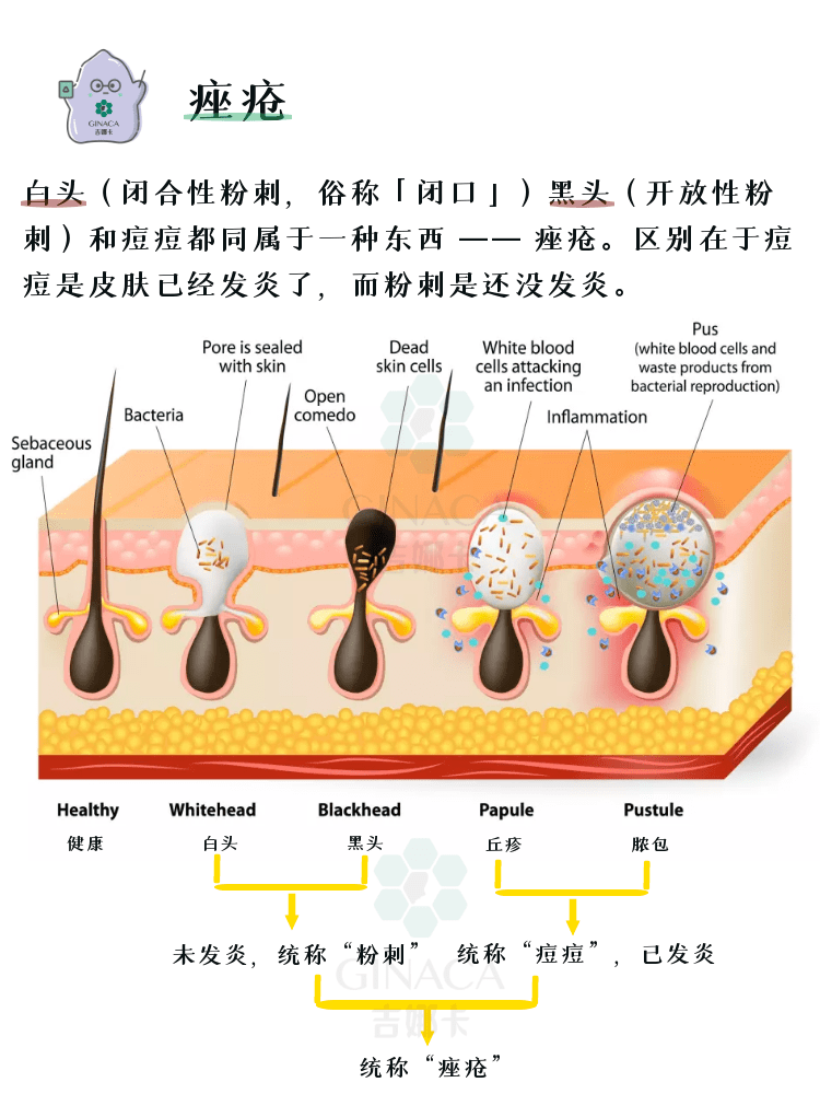 如何祛痘治疗最全攻略