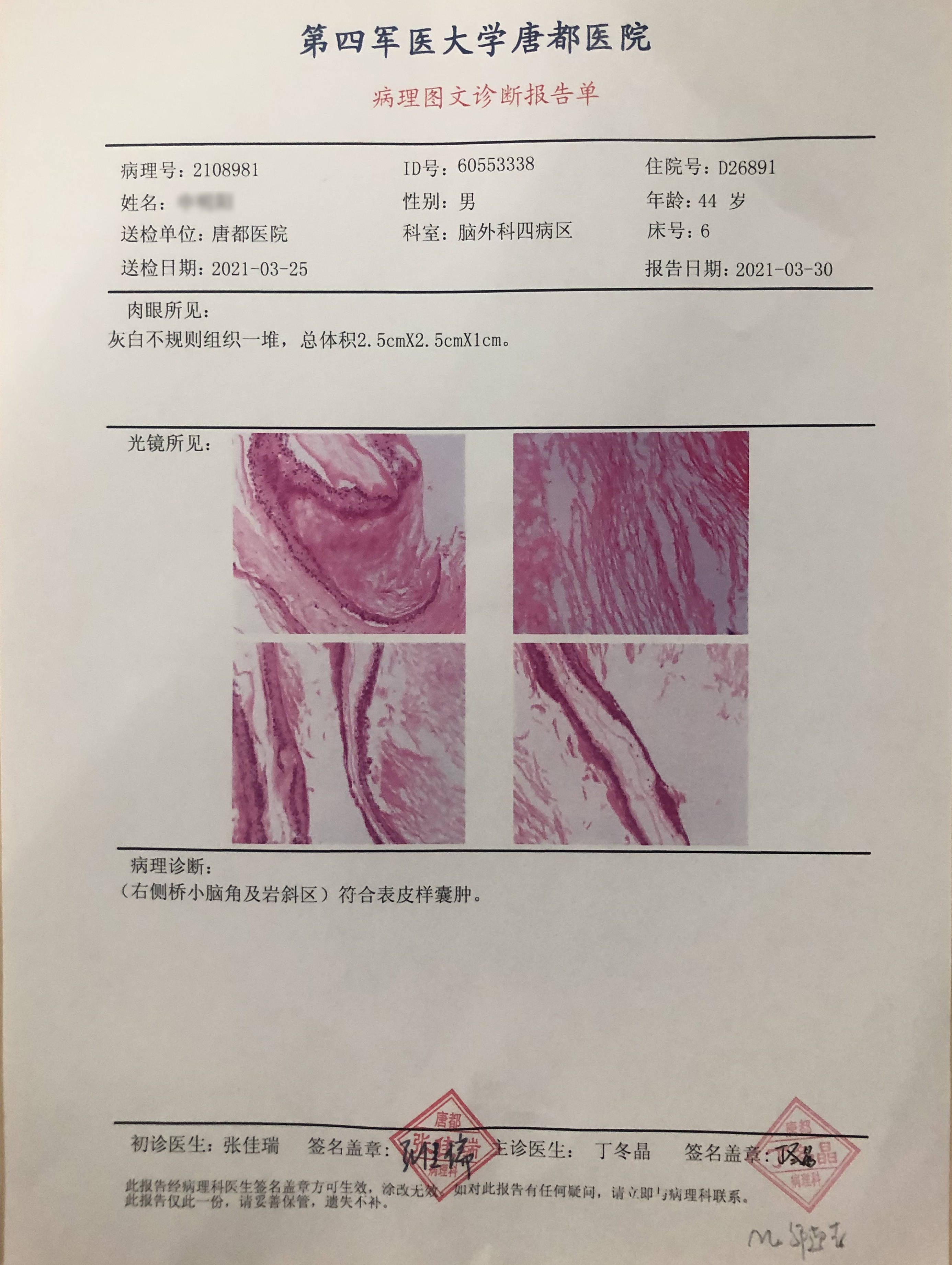 术后病理结果:(右侧桥小脑及岩斜区)符合表皮样囊肿术后1月复诊,送