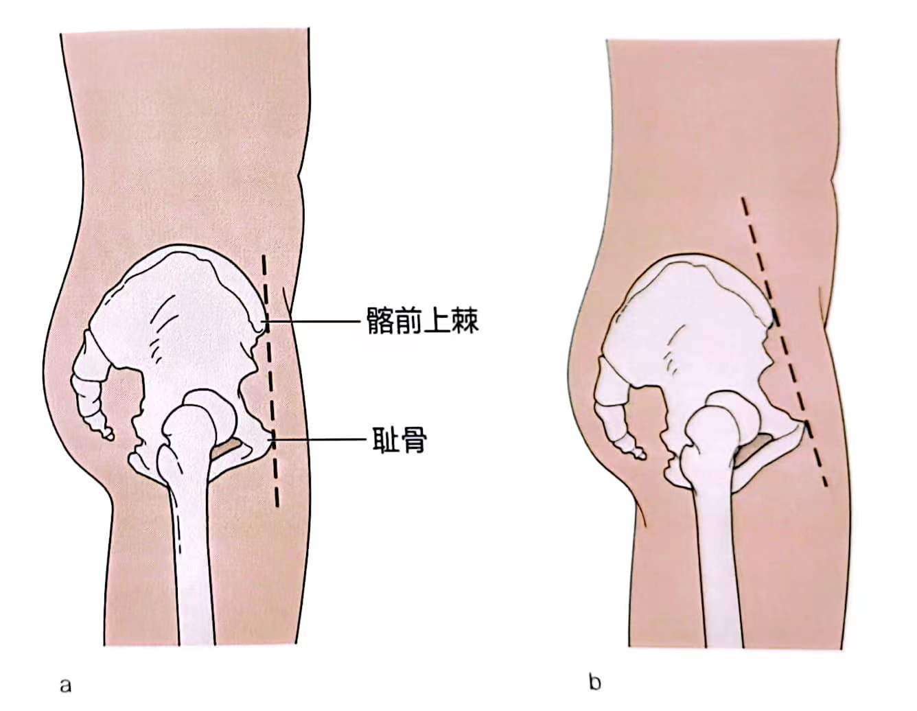 髂结节体表定位图图片