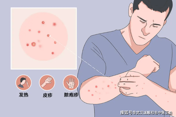 身上起水泡很疼怎麼回事武漢治療皮膚病專科醫院