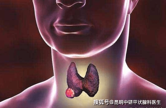 【昆明中研甲状腺医院】桥本甲状腺炎常见的4大并发症