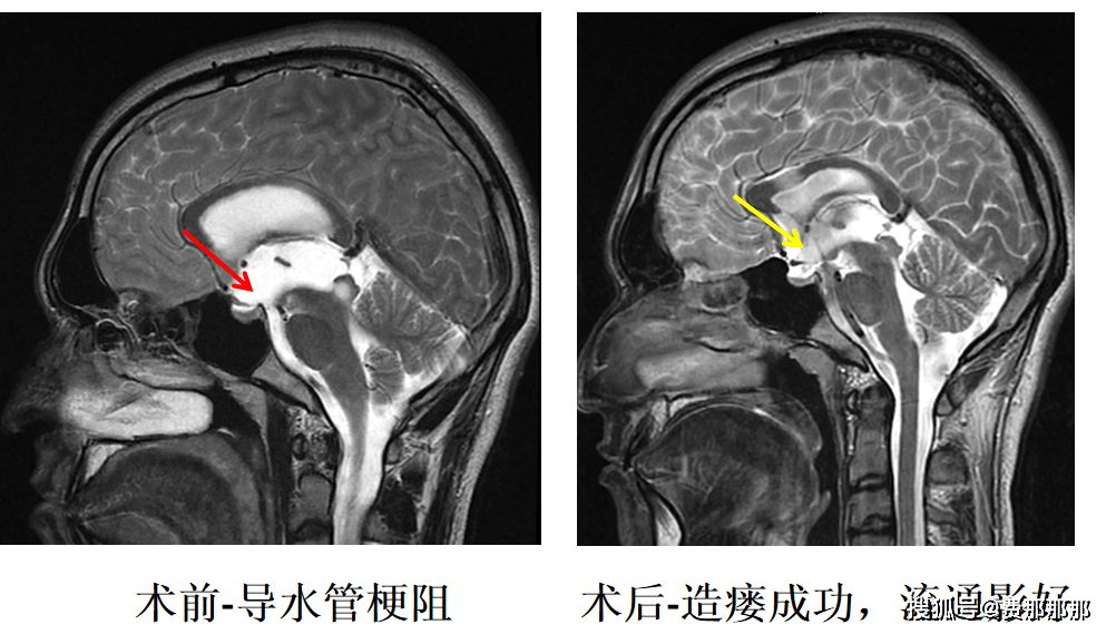 小尼_脑室_治疗