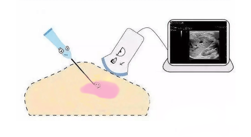 16岁少女咳嗽不止,经检查发现居然是结核_诊断_患者_淋巴结