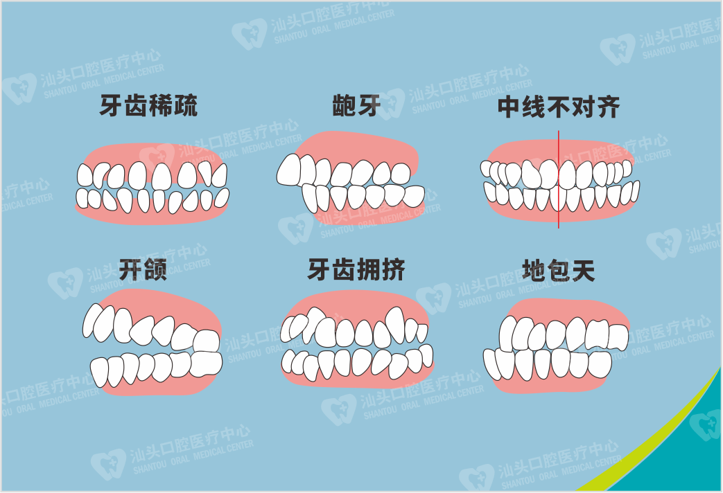 原创牙齿畸形影响口腔功能与健康孩子正畸黄金期请别错过