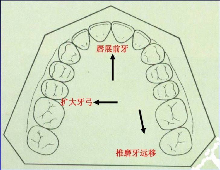 正畸治疗中的推磨牙是怎么回事?_牙齿_移动_矫治
