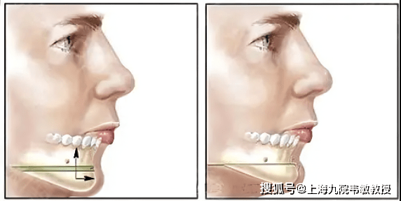 下巴截骨前移是颅颌面最早的截骨技术之一,是把下颌骨前移,主要对下巴
