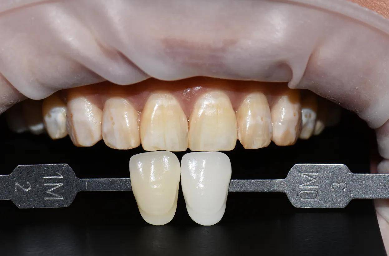 【氟斑牙】氟斑牙的形成_氟斑牙怎么去除