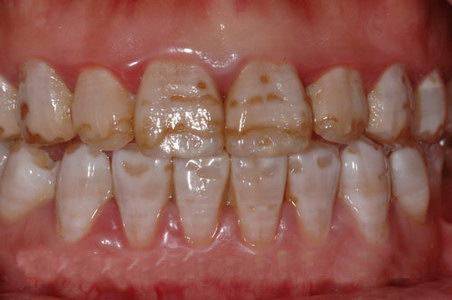 【氟斑牙】氟斑牙的形成_氟斑牙怎么去除