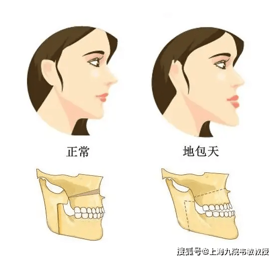 有些人不僅牙齒反頜,面部骨骼也畸形,表現為上頜骨發育不足——後縮