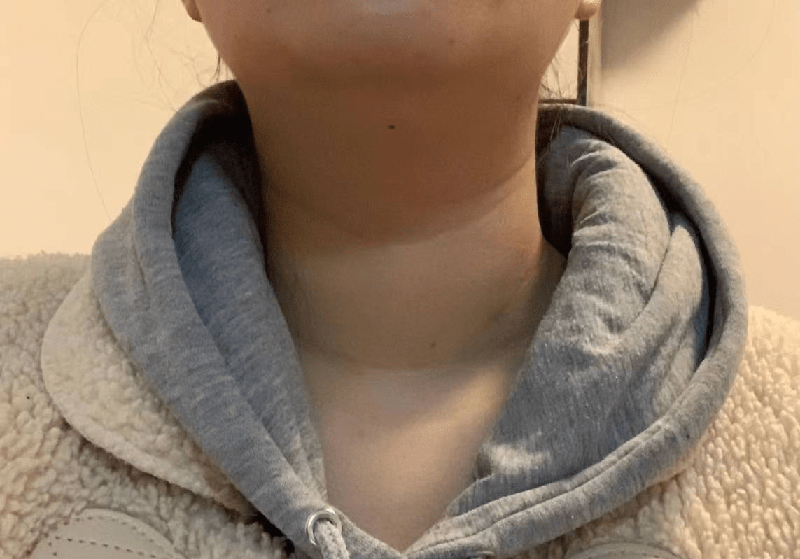 都2023年了还有人不知道甲亢怎么治?学会这个法子低成本一周见效!