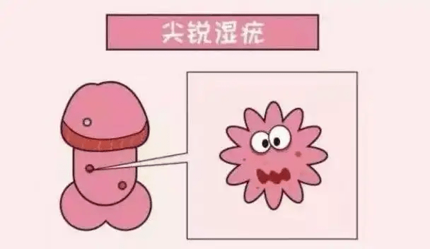 hpv和尖锐湿疣有关吗_病变_关系_为人