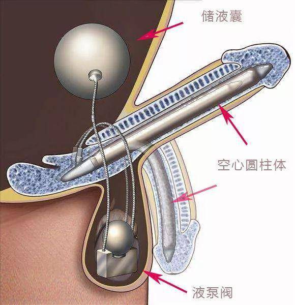 海绵体手术 人工图片