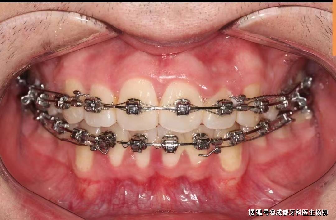 成都正畸医生杨柳科普:几种金属自锁牙套的区别?_进口_国产_案例
