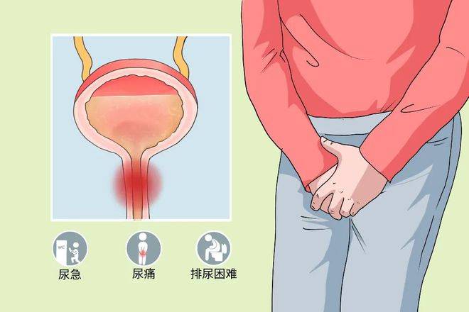 其临床表现主要为尿频、尿急、排尿困难、反复泌尿道感染，甚至尿潴留等。