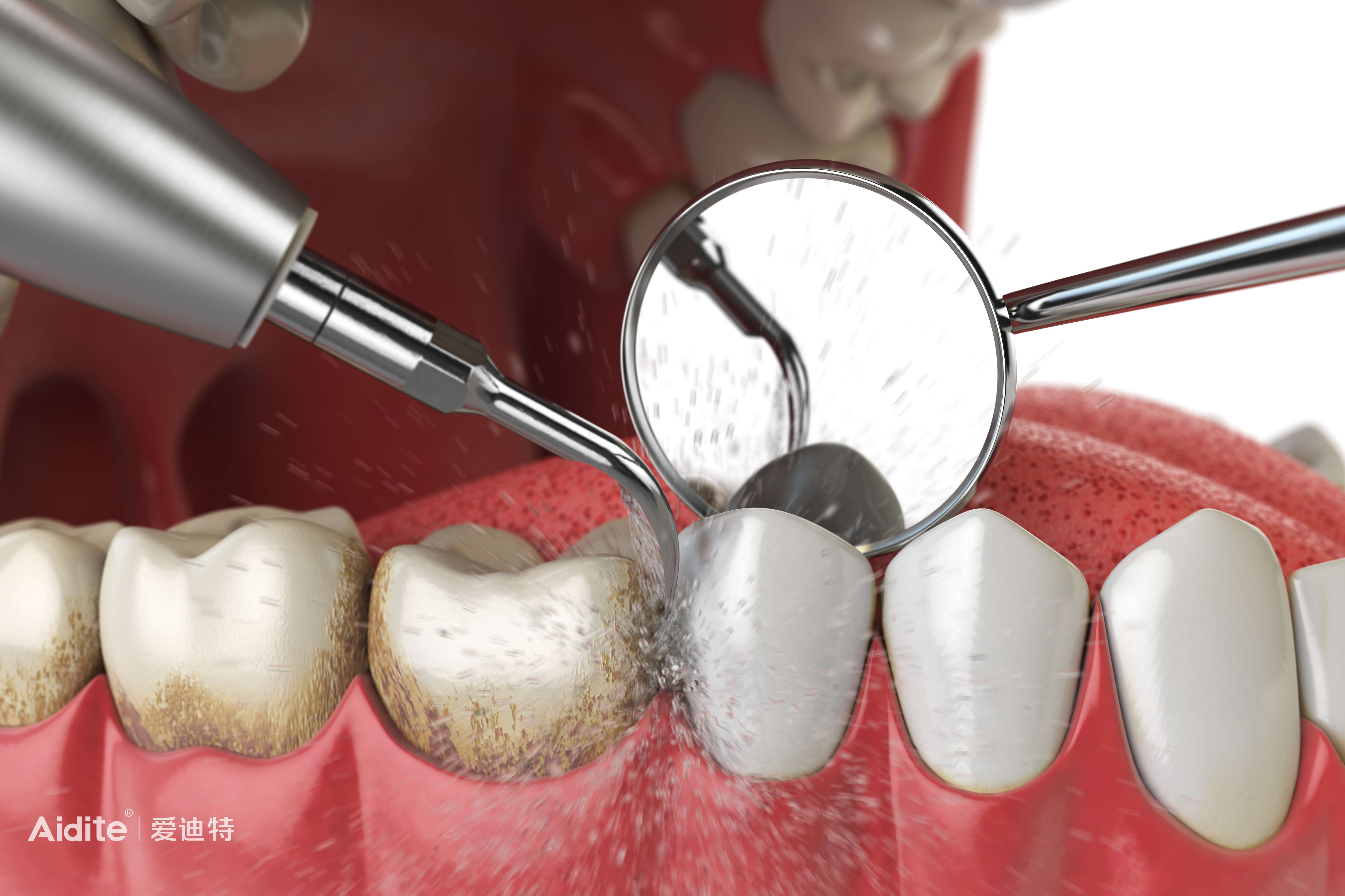 关于洗牙,你必须知道的那些事