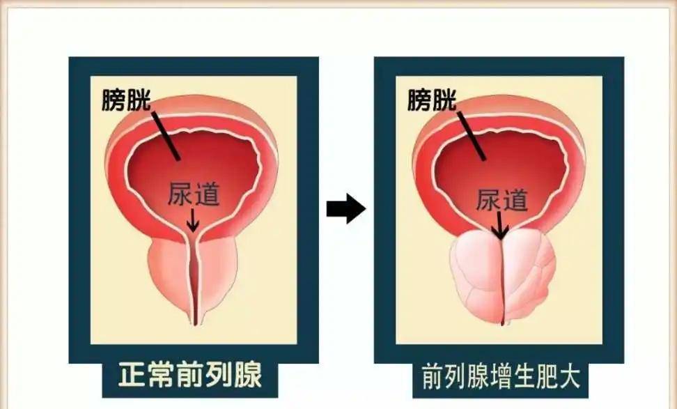 前列腺增生患者福音!几分钟的超微创手术你敢想吗?