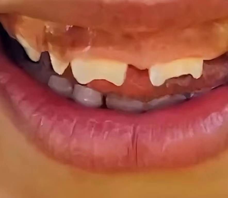 梅毒牙齿半月形的图片图片