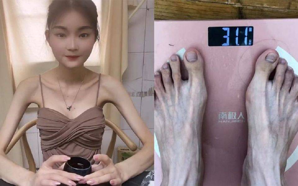 女孩疯狂减到50斤生命垂危,靠粪便成功挽救生命_移植_婷婷_体重