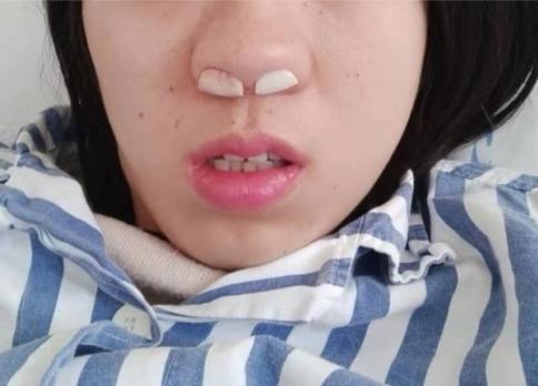 鼻子痒!鼻涕流!喷嚏打!鼻炎到底怎么办?_方法_康复_控制