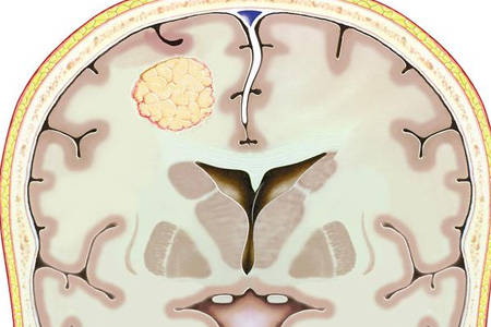 儿童脑白质发育不良能治愈吗?广州治脑瘫好的医院_治疗_孩子_家长