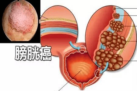 膀胱肿瘤图片 良性图片