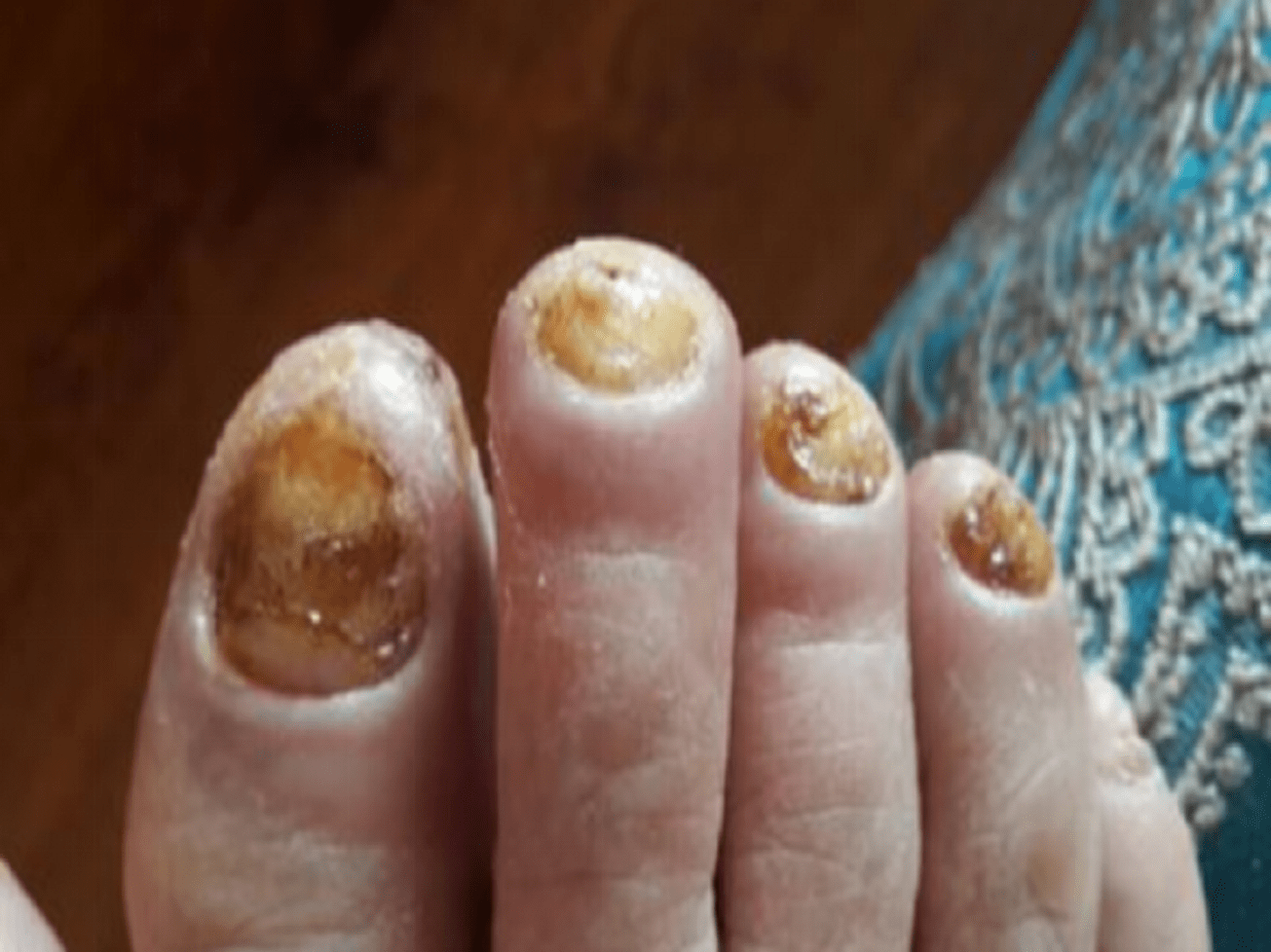 解决灰指甲最简单有效的方法!过来人无偿分享!建议收藏!