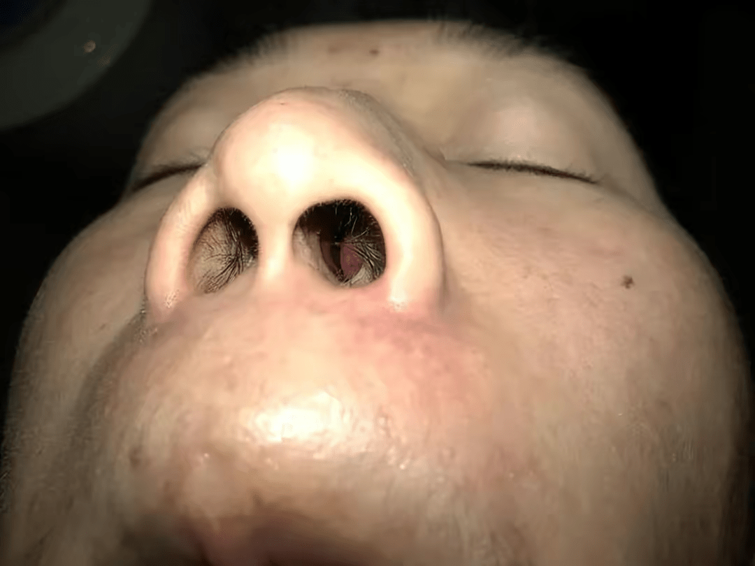 可算是摆脱严重鼻炎鼻塞的折磨了!_时候_粉尘_鼻子