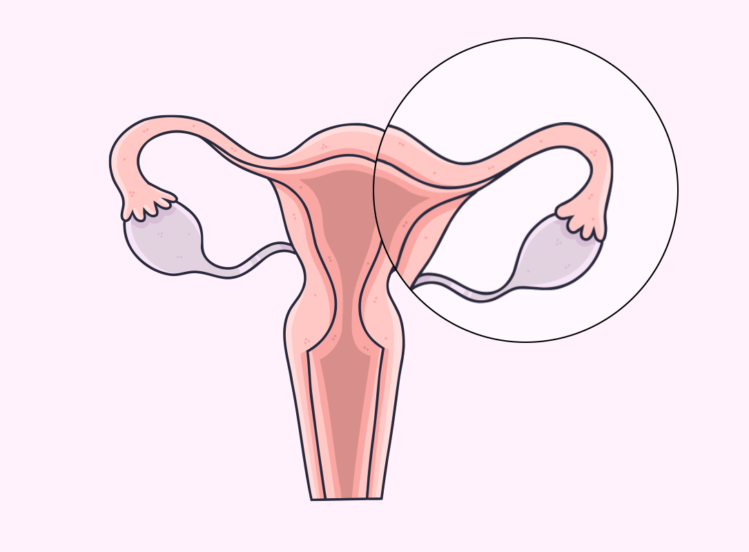 作为女性生殖系统的一员,输卵管的作用是帮助女性自然受孕,这是它唯一