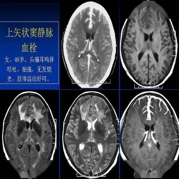 新生儿缺氧缺血性脑病的ct诊断